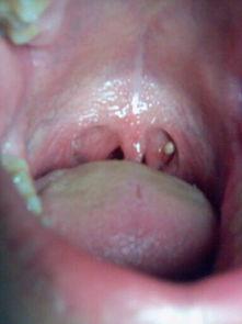 吃白皮瓜嗓子发炎,揭秘嗓子发炎的饮食隐患