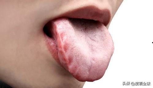 吃瓜舌头麻木,揭秘奇特现象背后的真相 第3张 吃瓜舌头麻木,揭秘奇特现象背后的真相 第3张