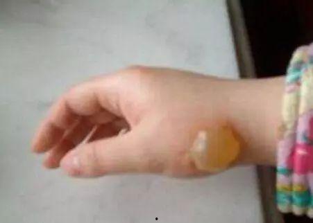 被烫伤敢吃凉瓜吗吗,揭秘饮食恢复之道