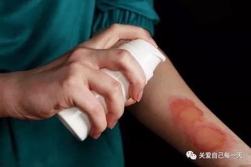 被烫伤敢吃凉瓜吗吗,揭秘饮食恢复之道  第2张