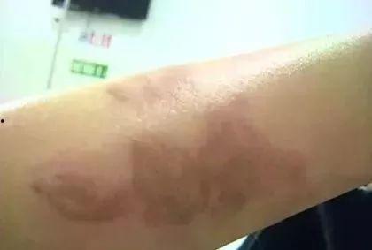 被烫伤敢吃凉瓜吗吗,揭秘饮食恢复之道  第3张